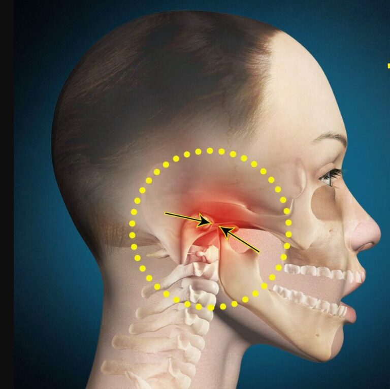 TMJ Disorder