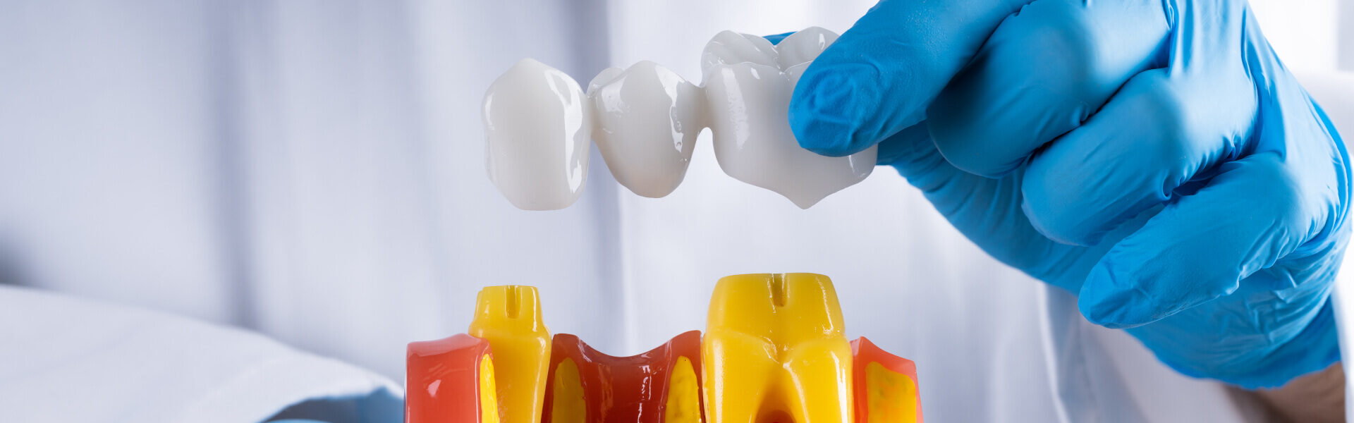 Dental Bridges