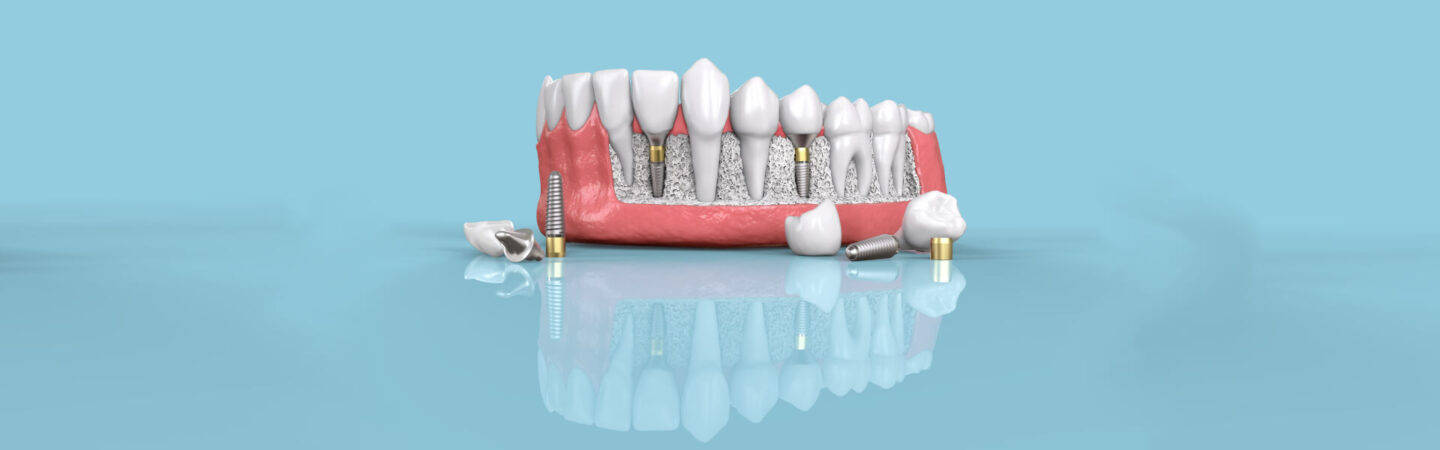 Dental Implants