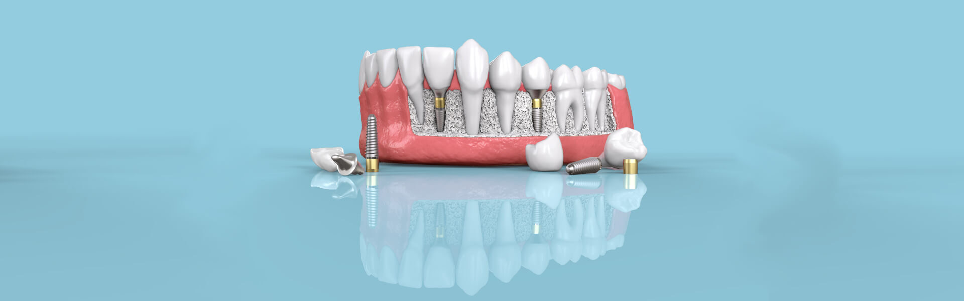 Dental Implants