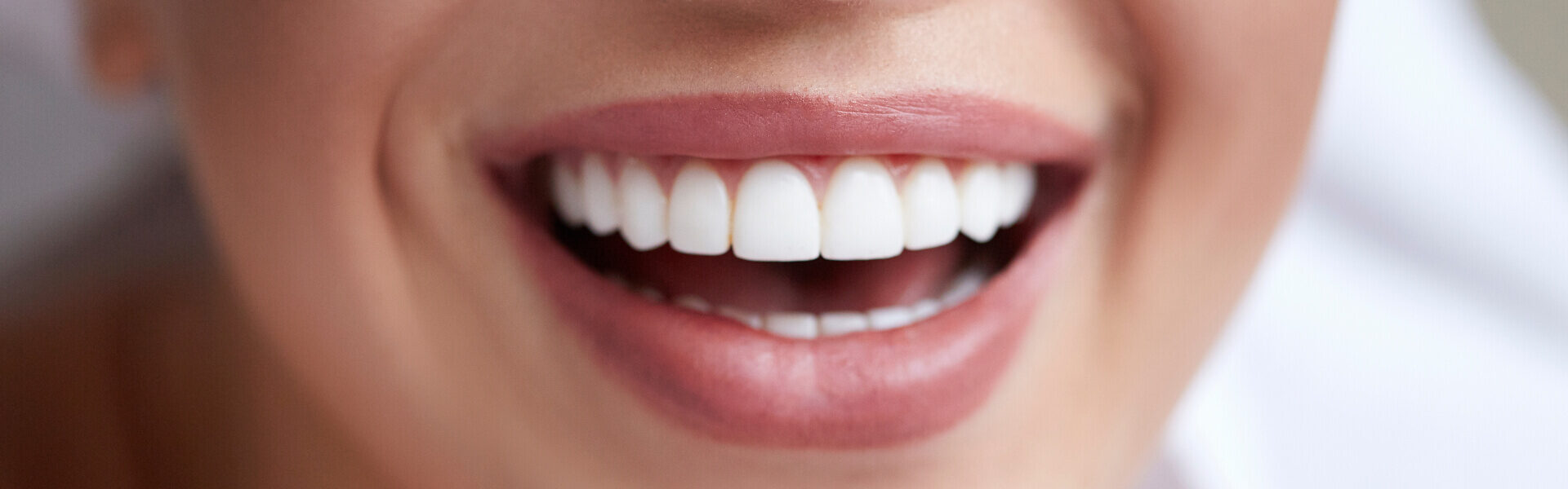 Veneers