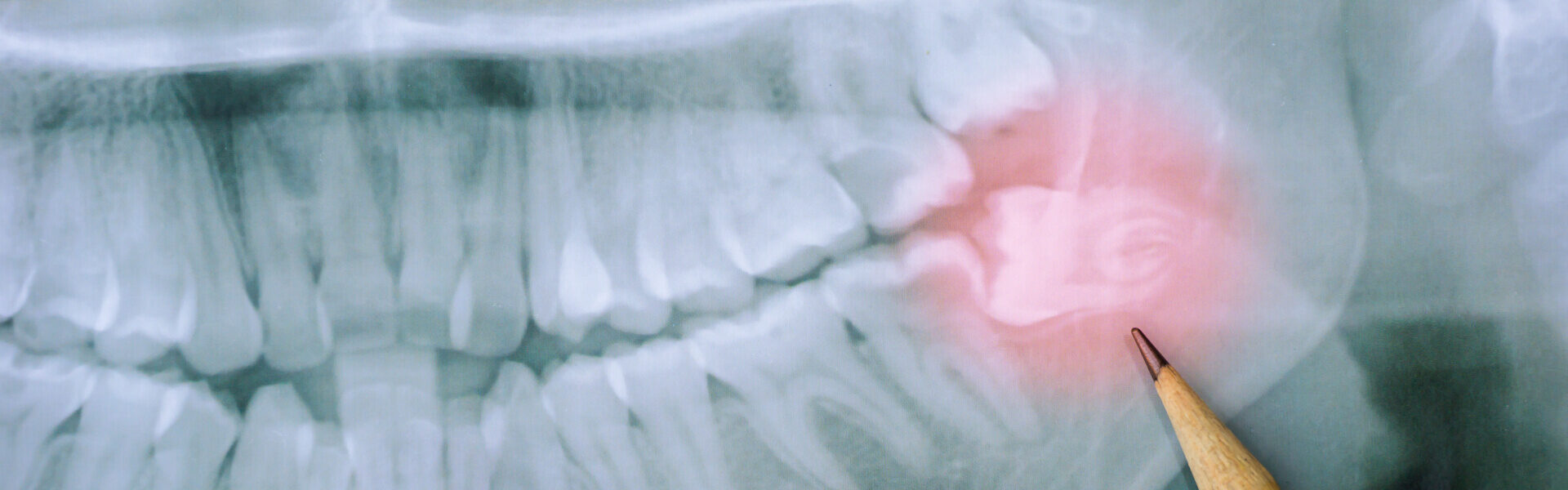 Wisdom Teeth